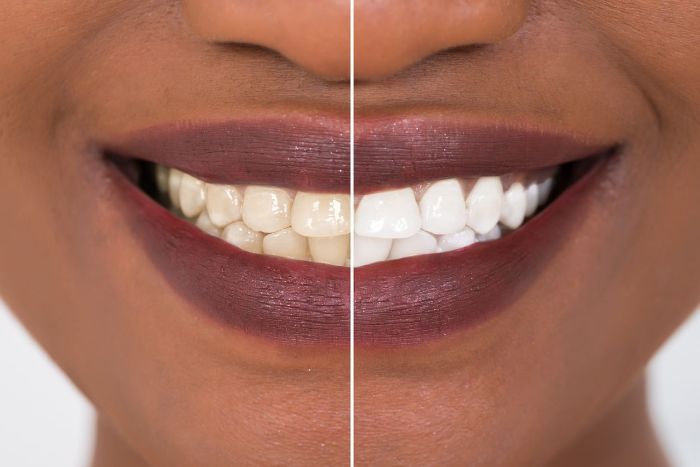 Smiling African American, Teeth Whitening
