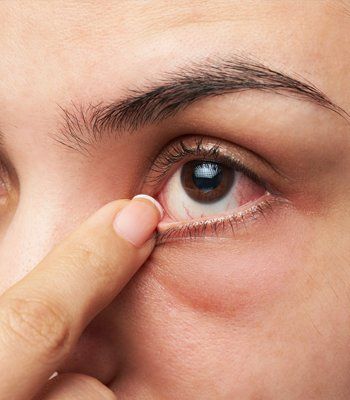 Eye Infection — woman show her eye in Belleville, IL