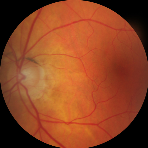 Eye retina, showing blood vessels, optic disc, and macula, in shades of red and orange.