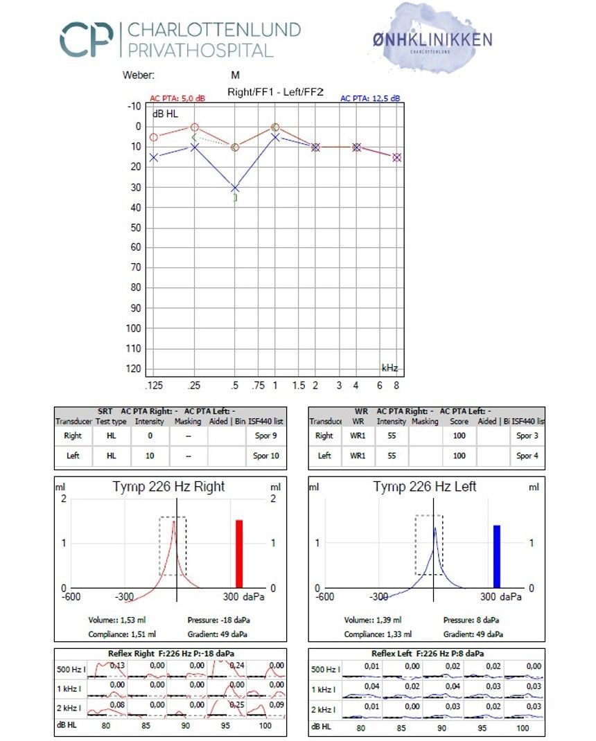 Audiogram och tympanometriresultat från en läkarundersökning. Visar hörtrösklar, tympanogram för vänster och höger öra.