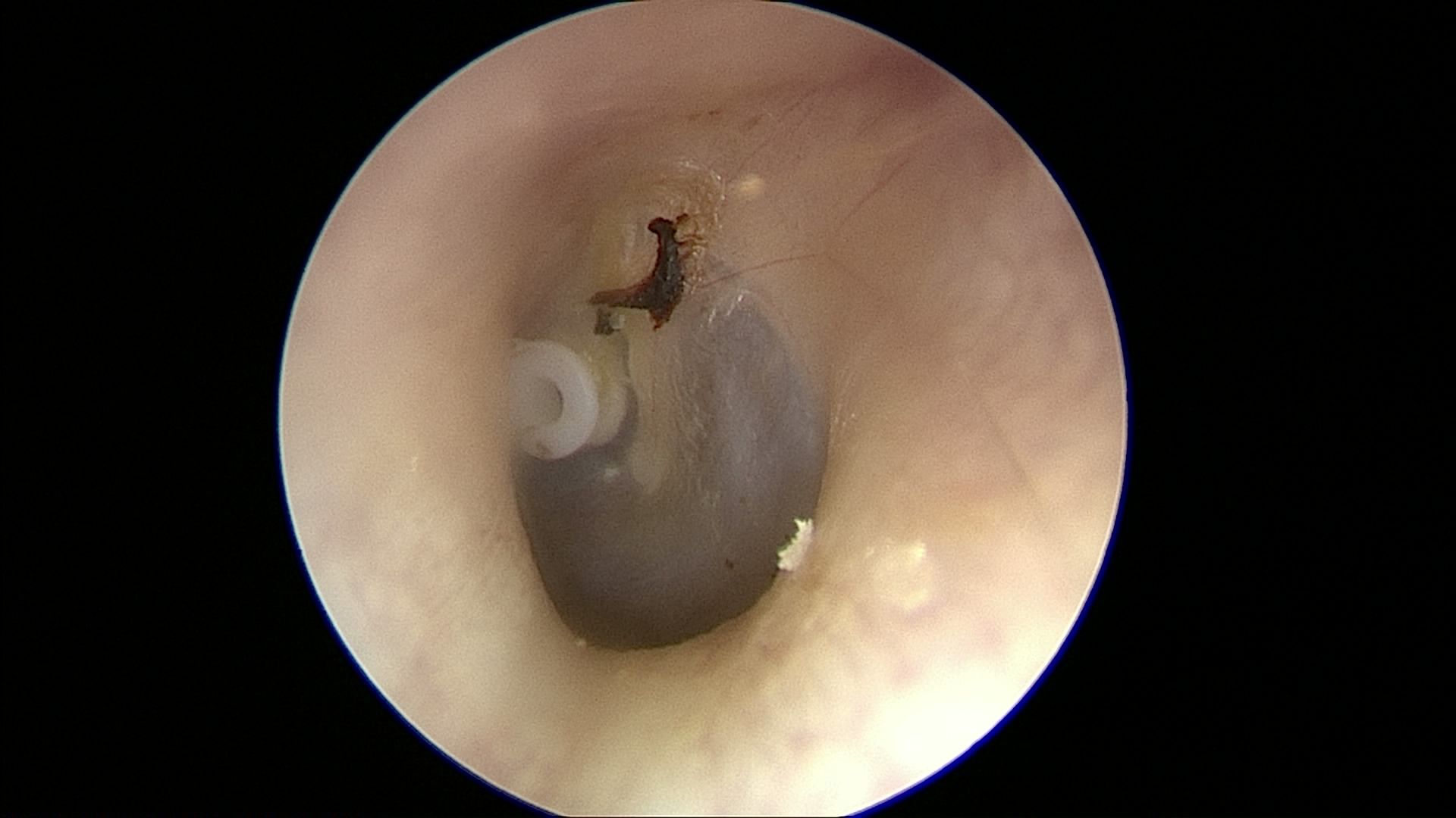 En närbild av insidan av en hörselgång med ett mörkgrått föremål och ett litet instrument i mitten.