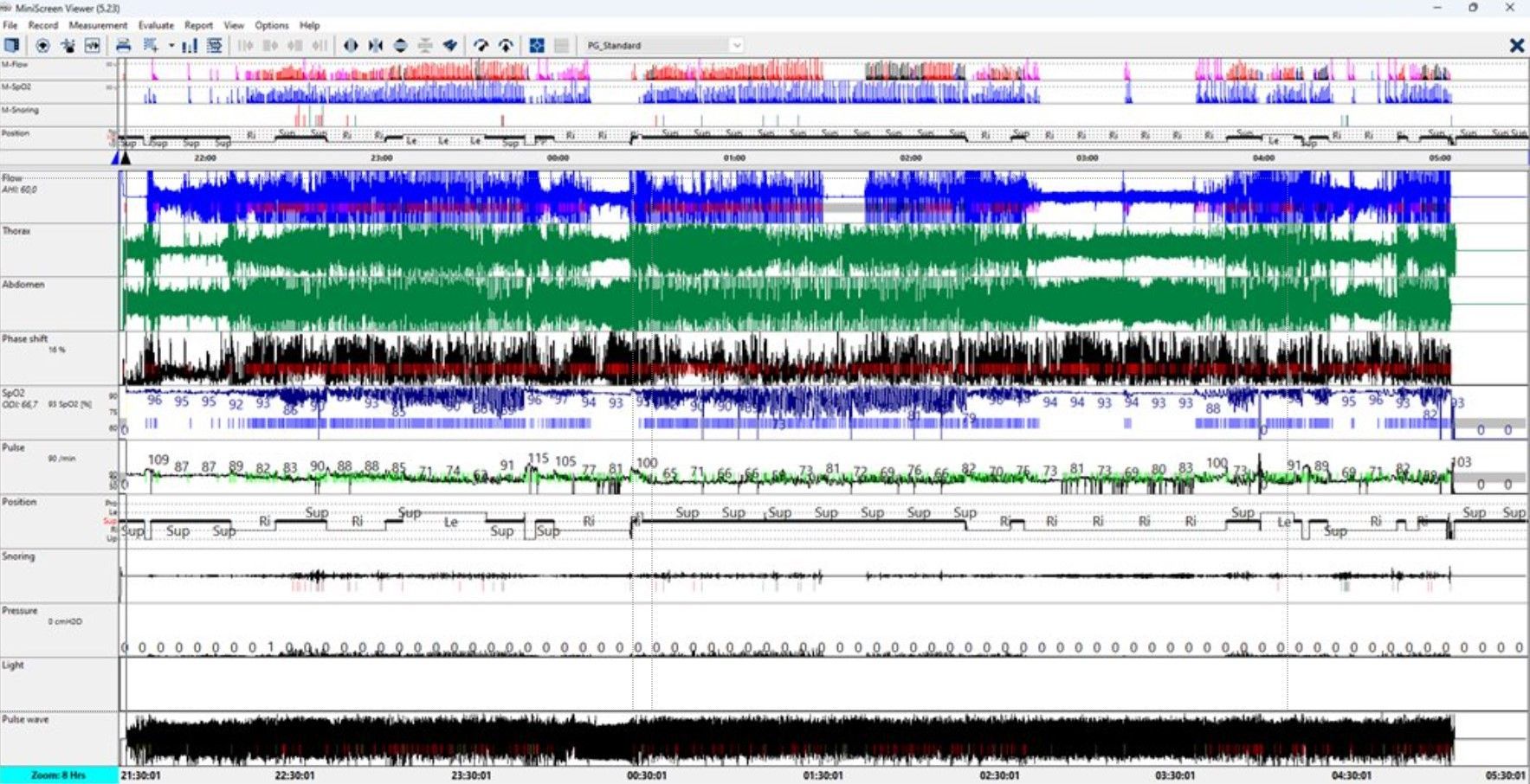 Skärminspelning av datavisualisering med olika färgade vågformer, troligen medicinska data.
