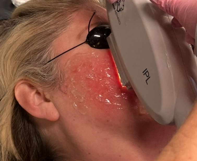 Woman receiving IPL facial treatment; red face, safety glasses, laser device.