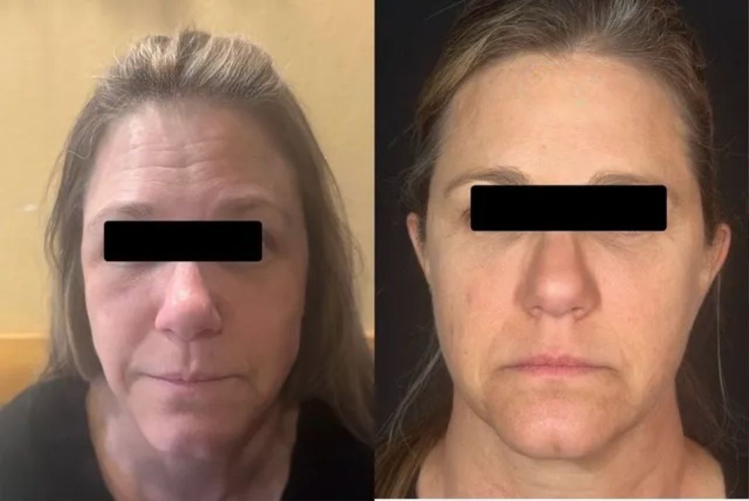 Before-and-after photos of a woman's face; showing reduced wrinkles and smoother skin after a cosmetic procedure.