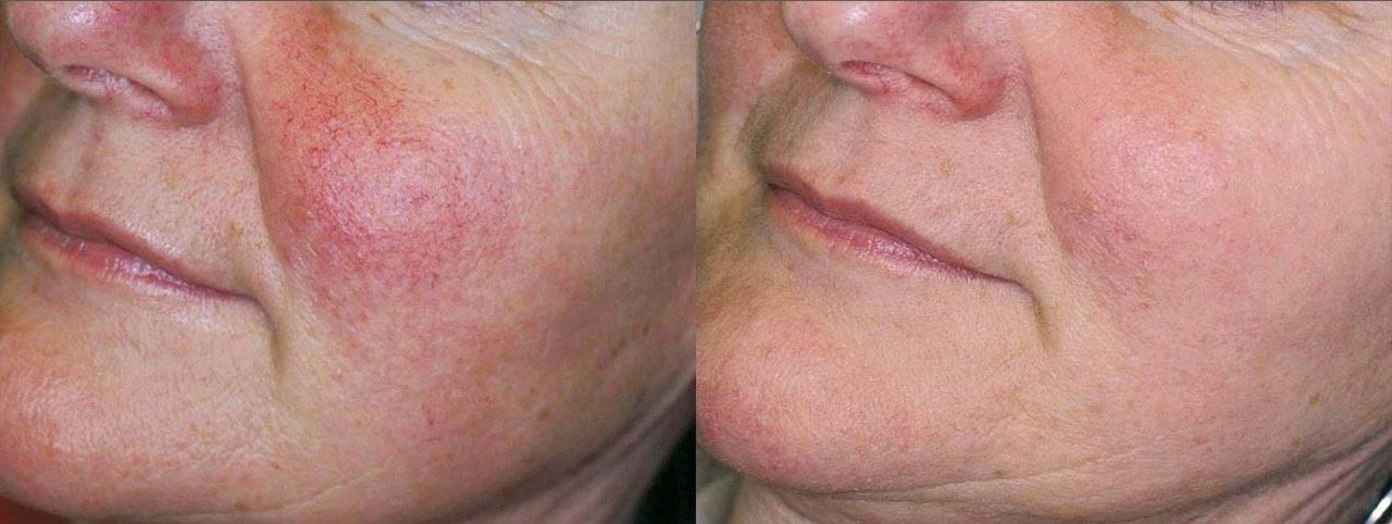Side-by-side comparison of a person's face with rosacea before and after treatment; redness is reduced.