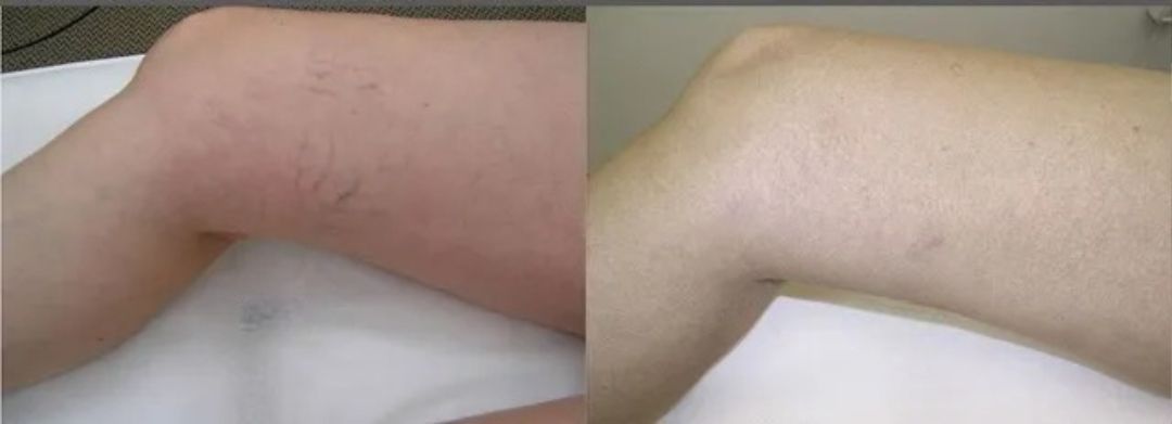 Leg with knee joint, before and after treatment, showing changes in skin appearance.