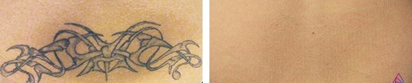Before and after tattoo removal: a tribal tattoo on skin fades to a blank area after removal.
