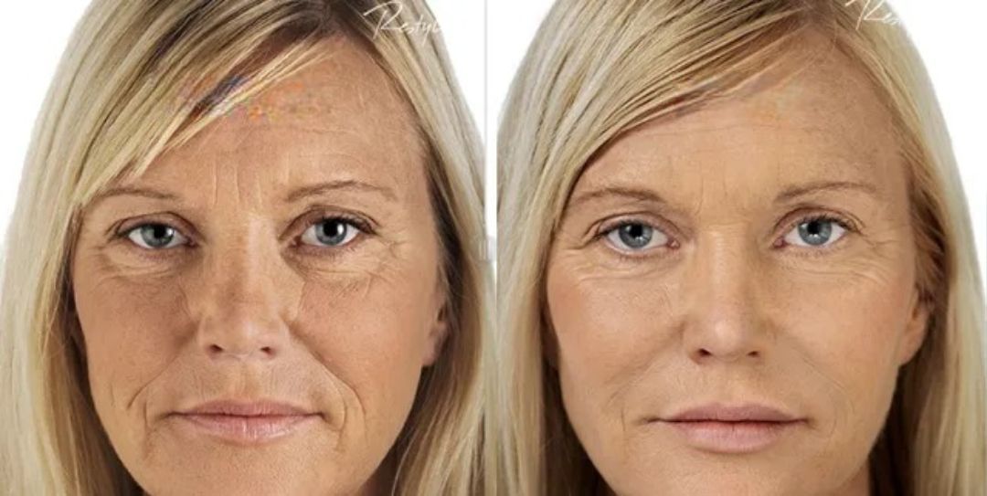 Side-by-side comparison of a woman's face before and after a cosmetic procedure, showing a reduction in wrinkles.