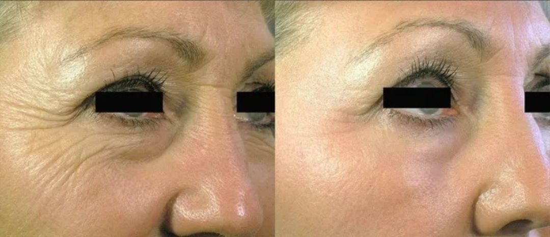 Before and after comparison of a woman's eye area, showing reduced wrinkles after cosmetic treatment.
