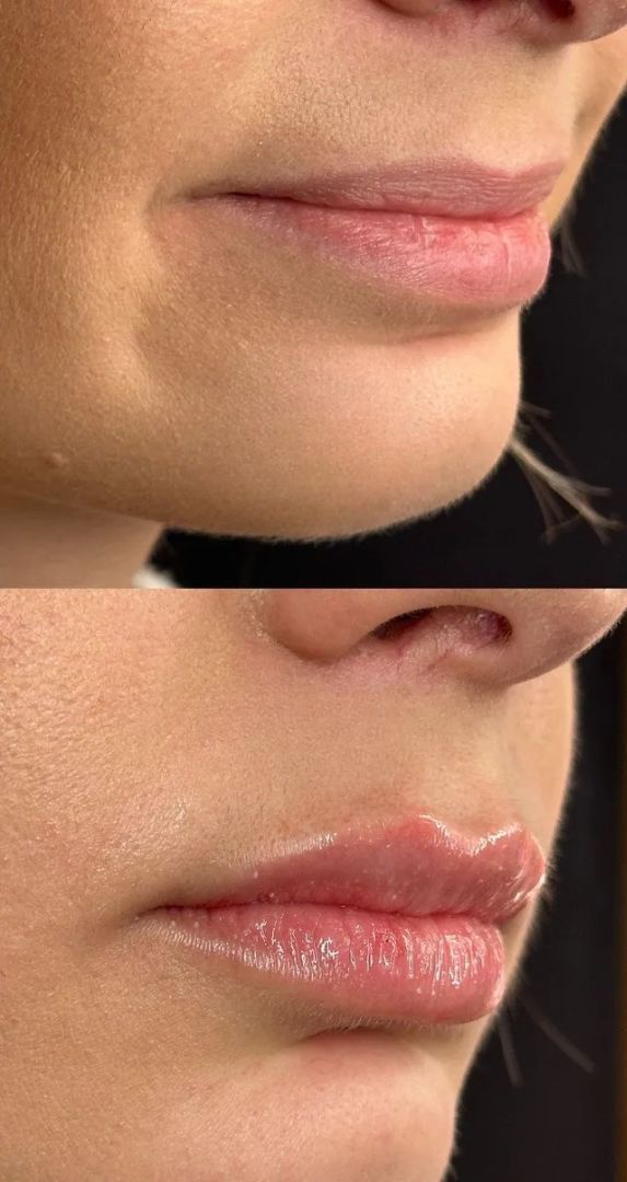 Before and after view of a person's lips, with enhanced fullness.