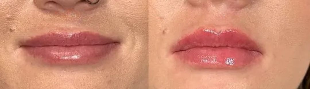 Comparison of lips before and after a cosmetic procedure, lips are glossy and pink.