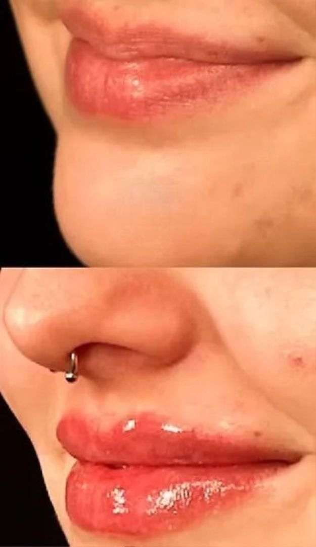 Top: Before and Bottom: After lip filler comparison. Glossy, plump lips. Includes a nose ring.