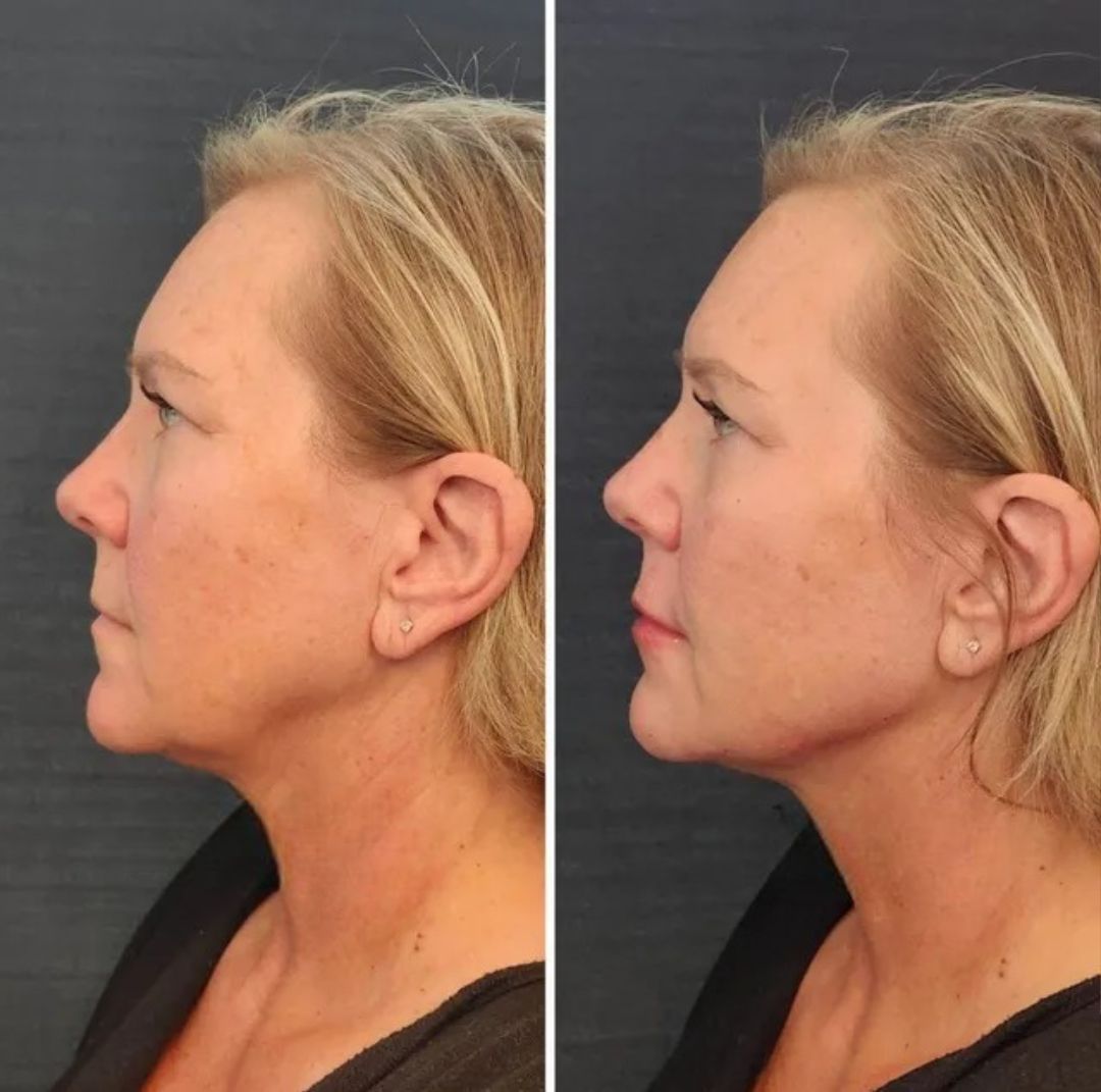 Side-by-side before/after views of woman's profile. The right shows a more defined jawline and reduced neck sagging.