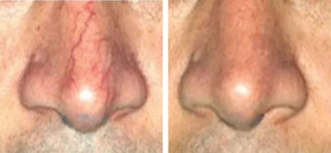 Before and after images of a nose. The left shows visible veins, the right is improved.