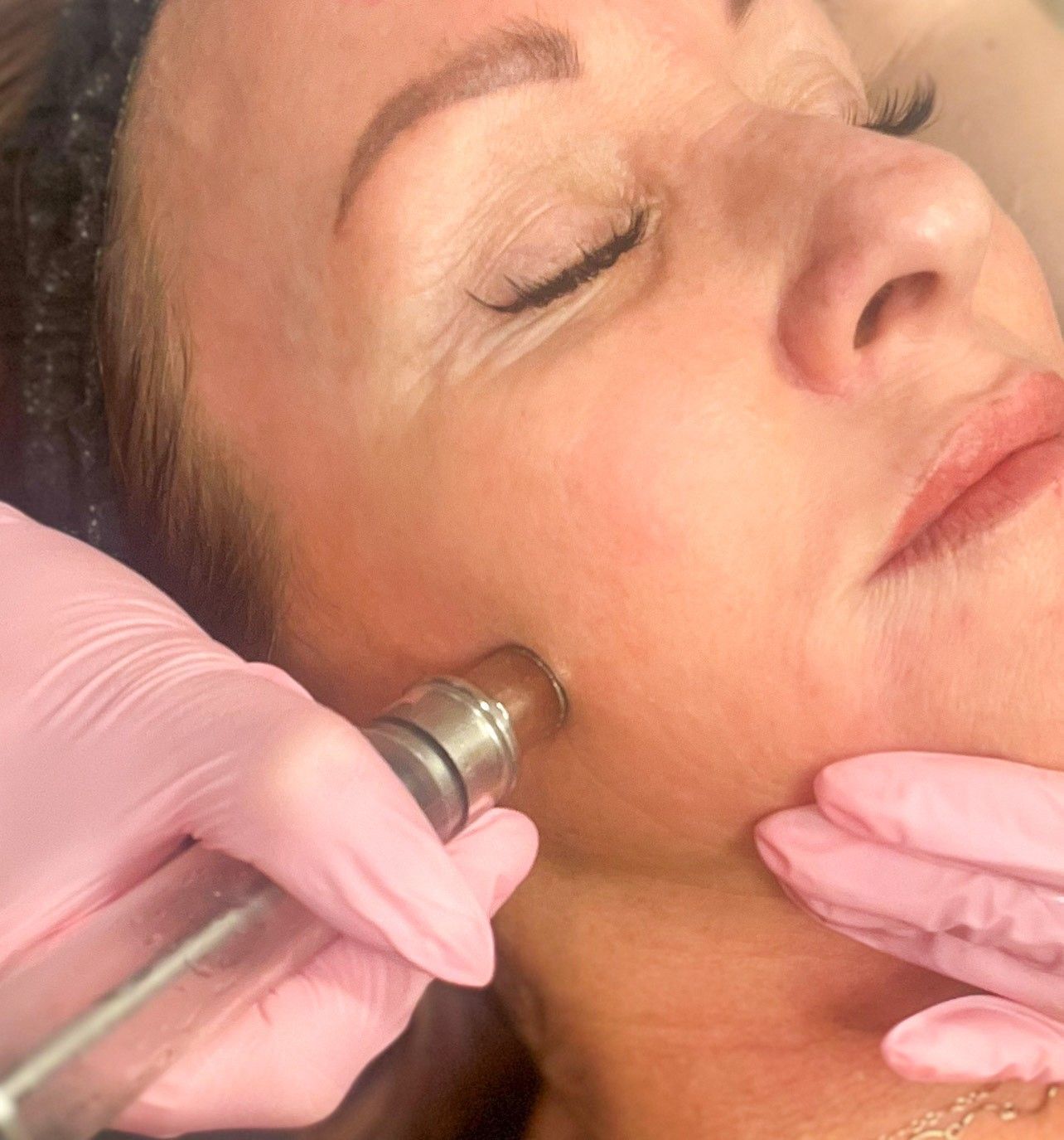 A woman receiving a facial treatment; a gloved hand uses a device on her cheek.