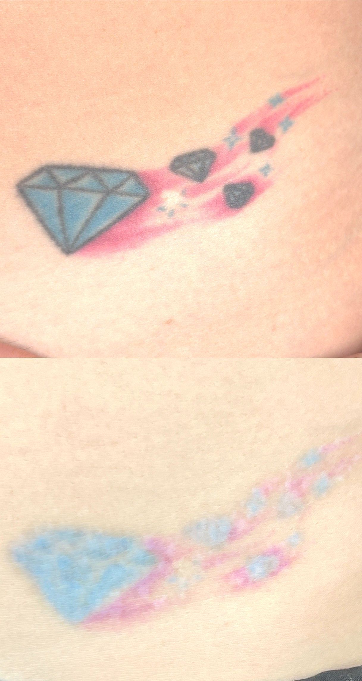 Before and after of a diamond tattoo. Original is vibrant; fading after treatment. Blue, pink, and black inks.