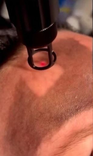 A close-up shows a red laser on a person's forehead, possibly for hair removal or a skin treatment.
