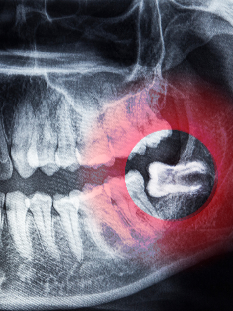 An x-ray of a person 's teeth with wisdom tooth growing in sideways