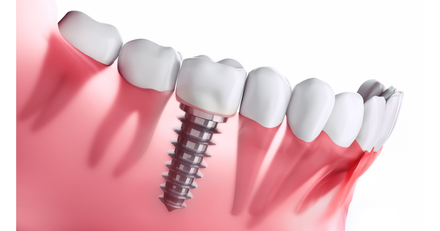 Dental Implant