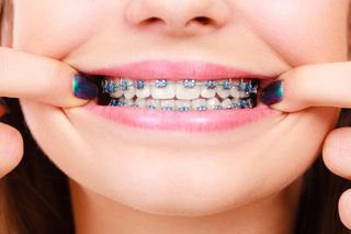 Braces— Woman with a Beautiful Smile at the Dentist in Colorado Springs, CO