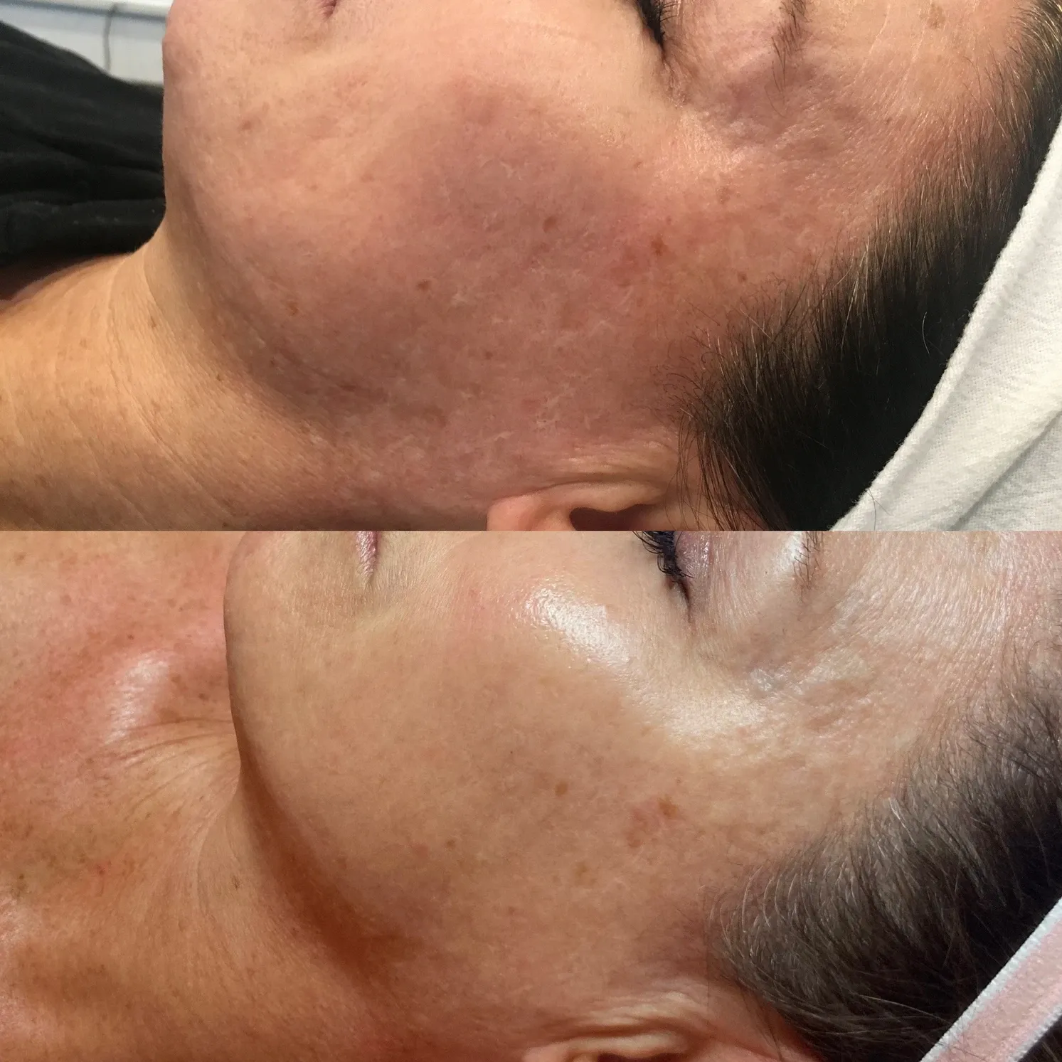 Microneedling for Acne Scars