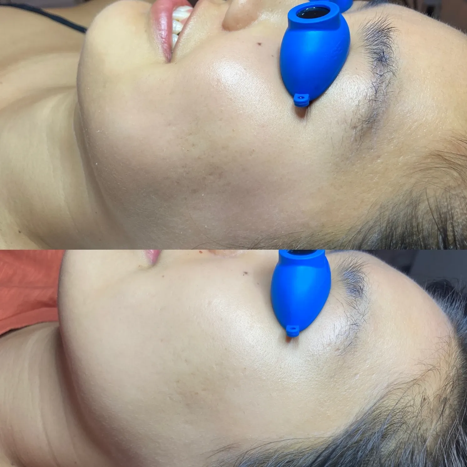 Microneedling Results 1 session