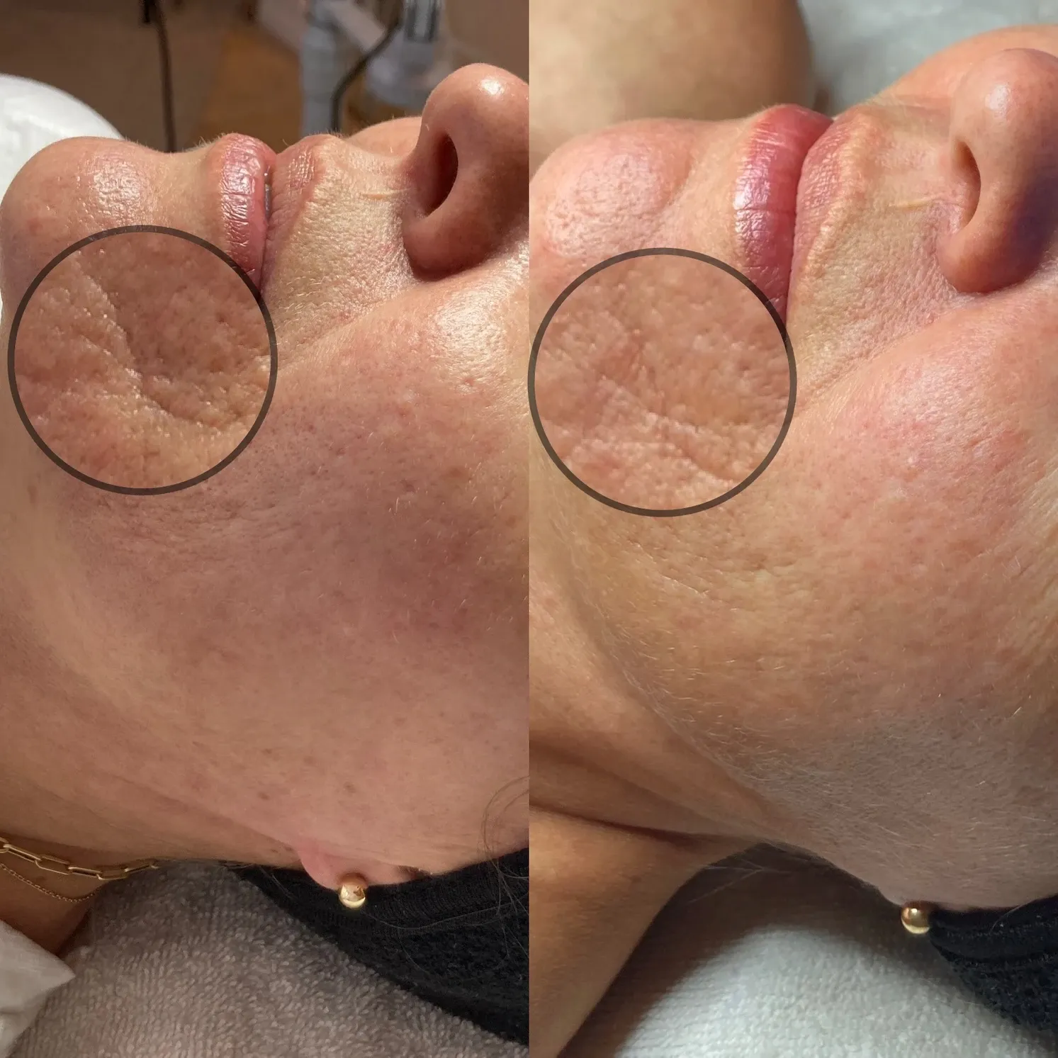 Microneedling for Skin Texture