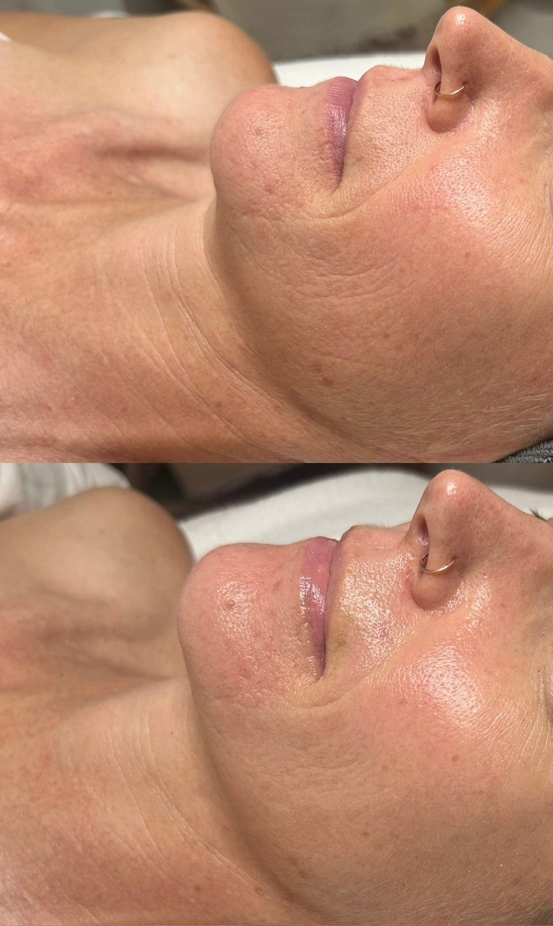 Denver anti-aging facial