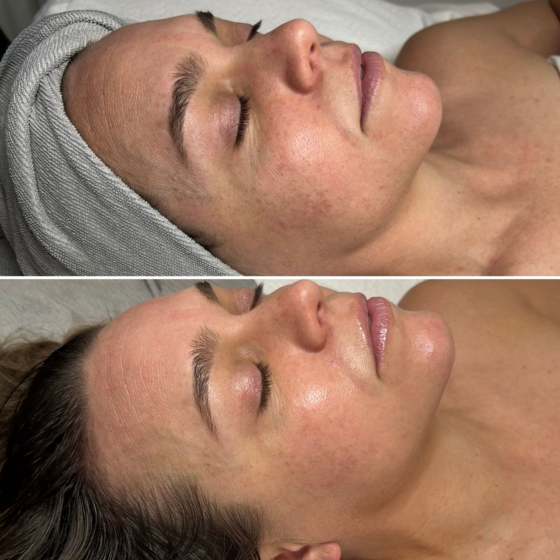 brightening facial skin care denver sun damage