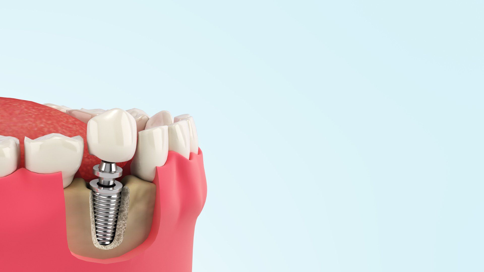 parodontologia e implantologia