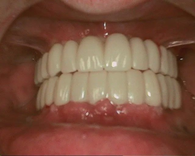 dental implants rancho cucamonga