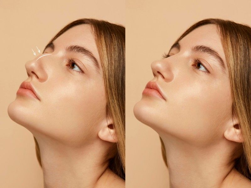 O rosto de uma mulher é mostrado antes e depois de uma cirurgia no nariz.