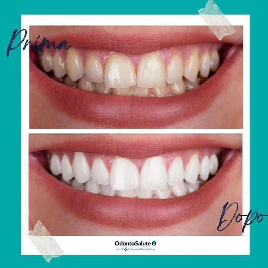 sbiancamento denti, foto prima e dopo
