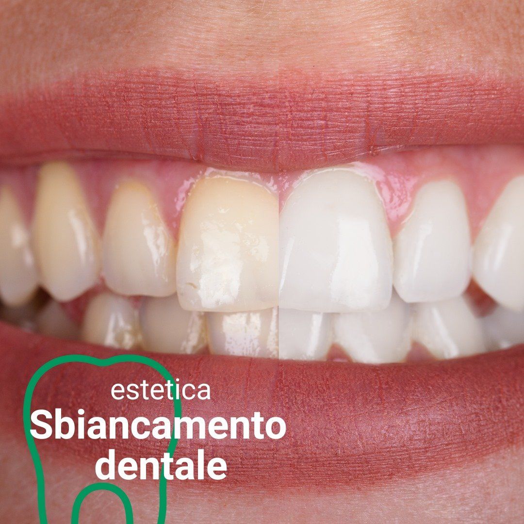 sbiancamento dei denti
