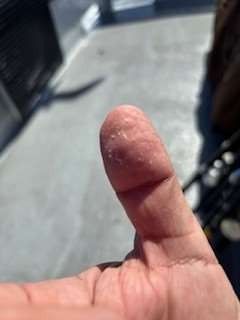 Thumb with dry, flaky skin on the fingertip. The background is a blurred outdoor scene.