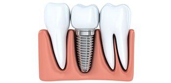 Implant Restoration—Cosmetic Dentistry in Fillmore, CA