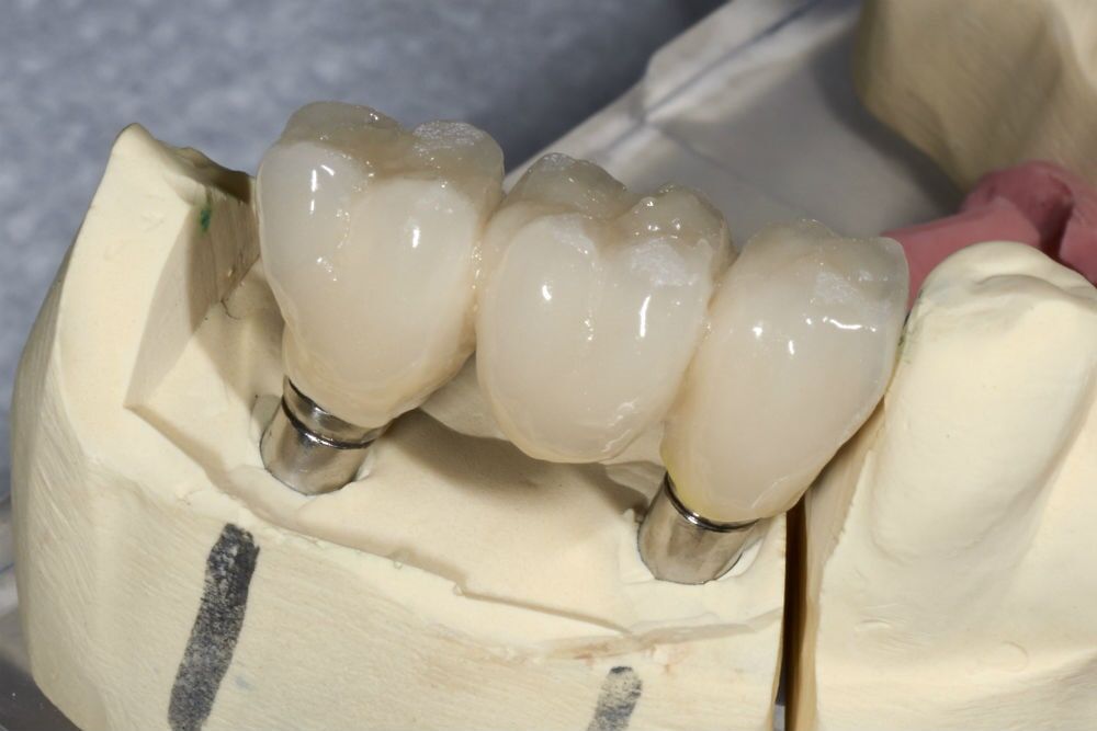 Dental Implants—Cosmetic Dentistry in Fillmore, CA