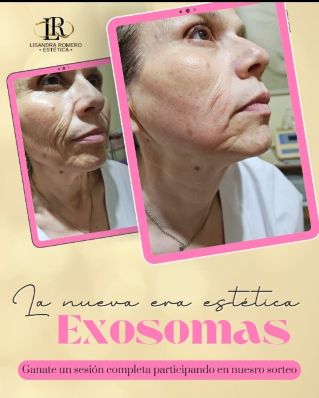 Un folleto promocional con imágenes del antes y el después de un tratamiento estético con exosomas