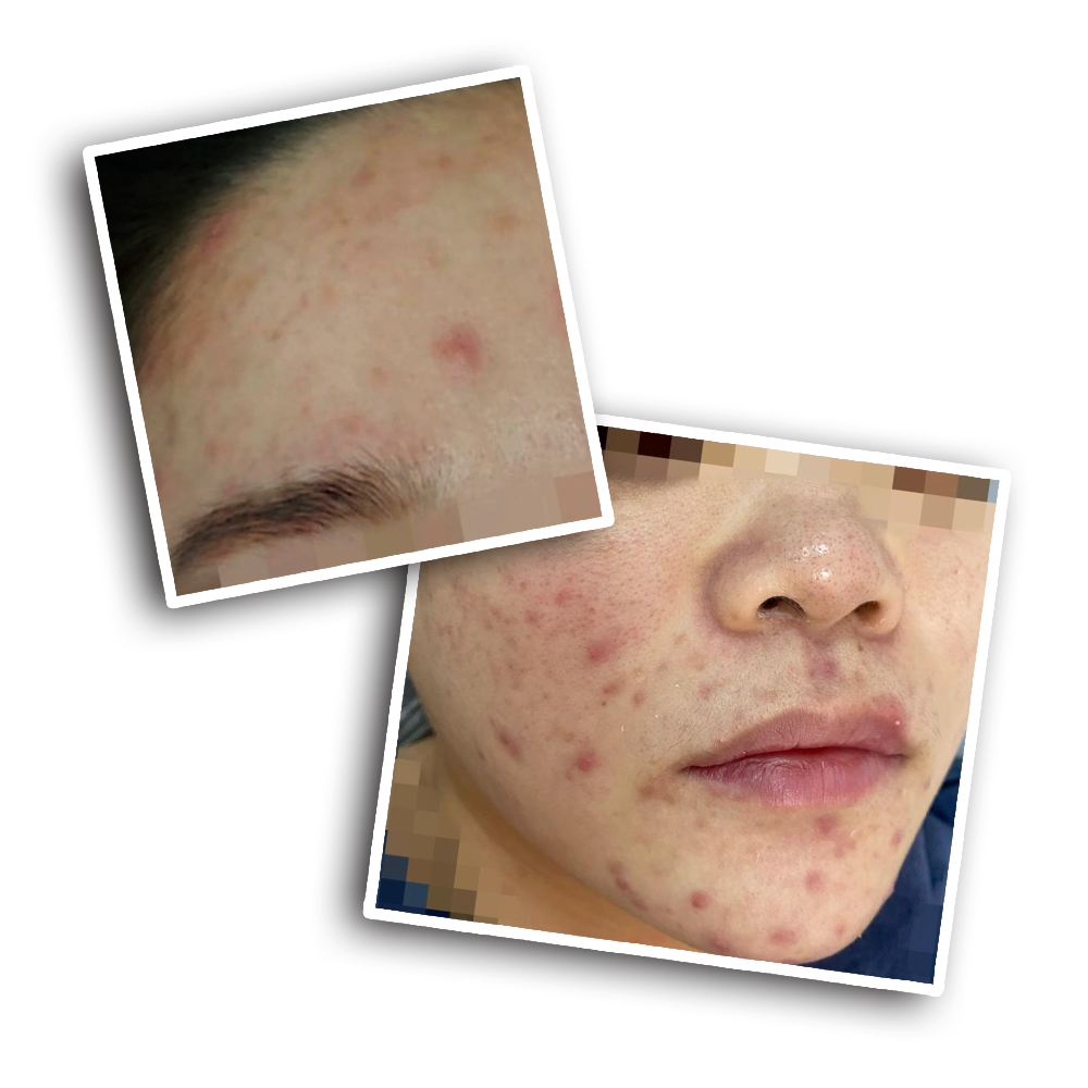 兩張女人臉上長痘痘的照片