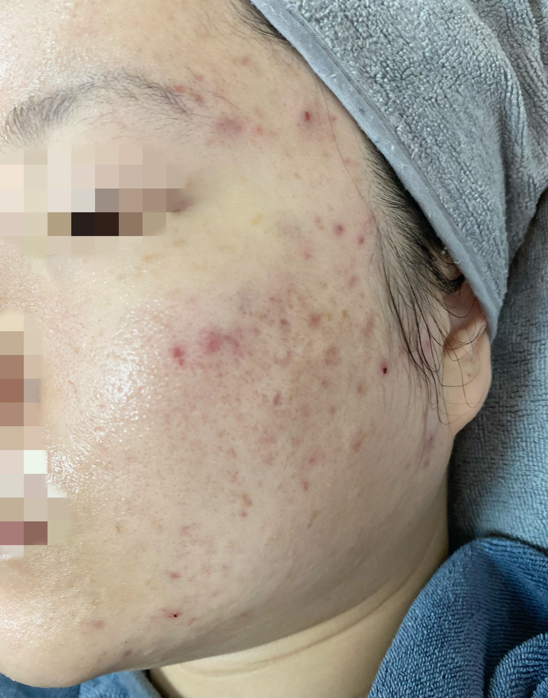 一個臉上長痘痘的女人頭上圍著一條毛巾。