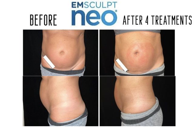 EmSculpt Treatment Specialist Near Me in Langhorne, PA