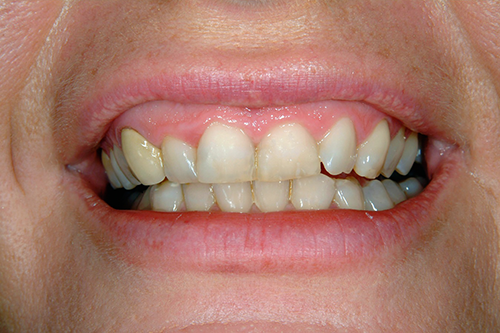 A close up of a person 's mouth with a broken tooth.