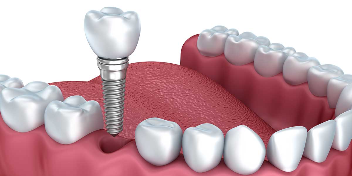an illustration of dental implants 