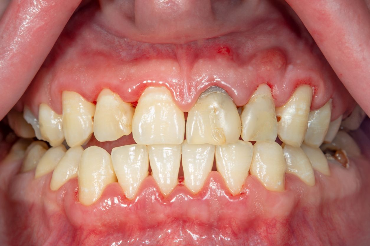 Symptoms of Gum Disease photo