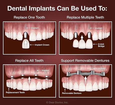 Is it Worth Getting a Dental Implant?