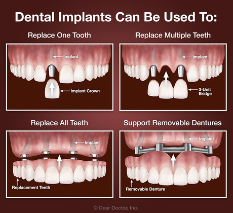 Front Tooth Filling