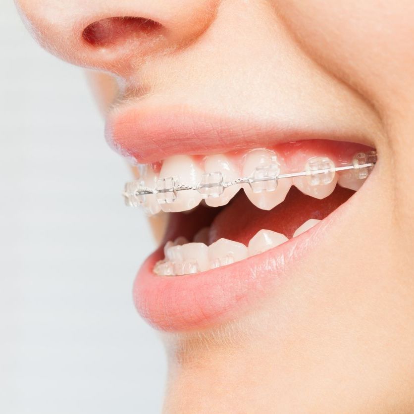 A close up of a woman 's mouth with braces on her teeth.