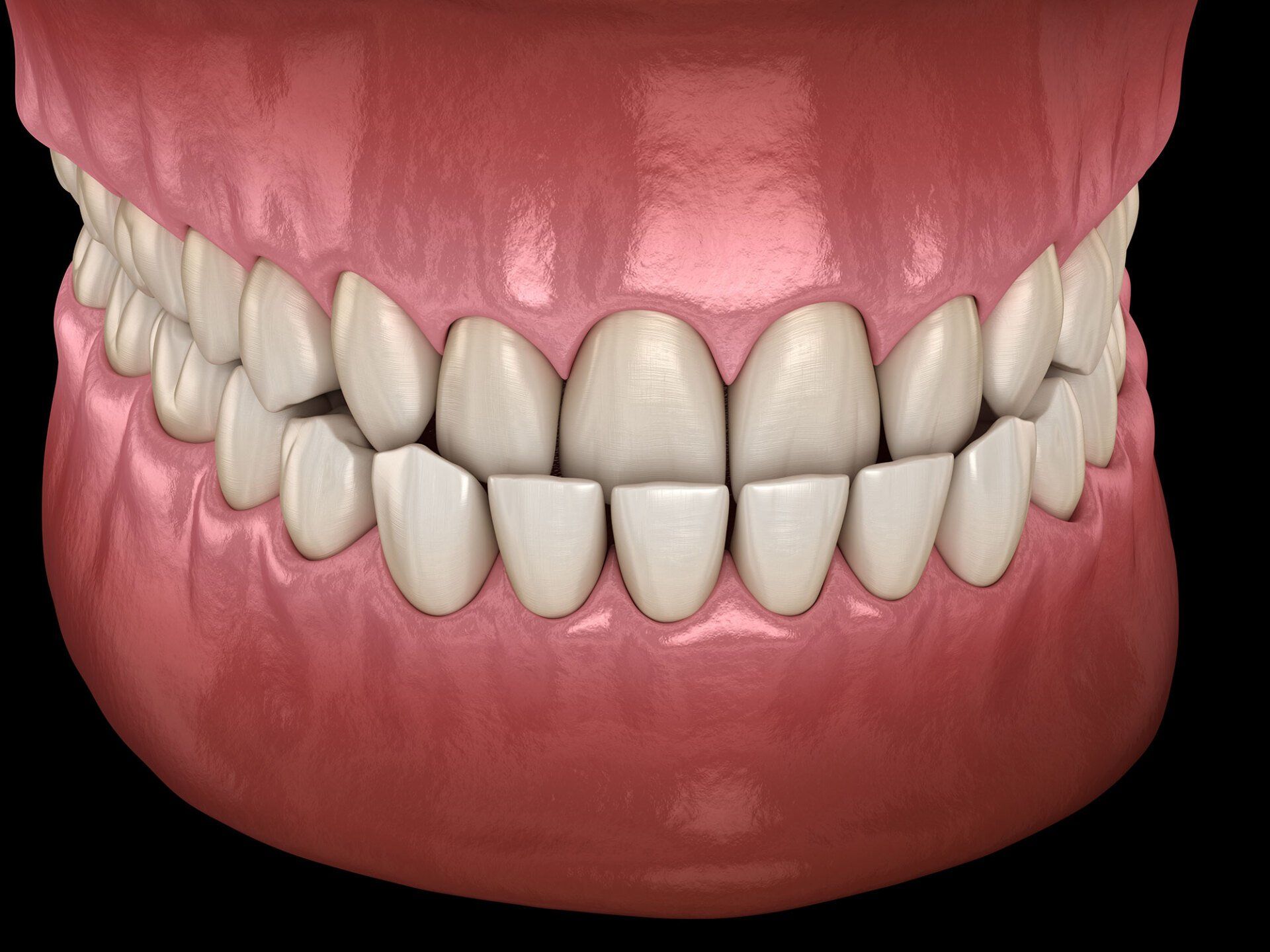 What Happens When You Have an Underbite?