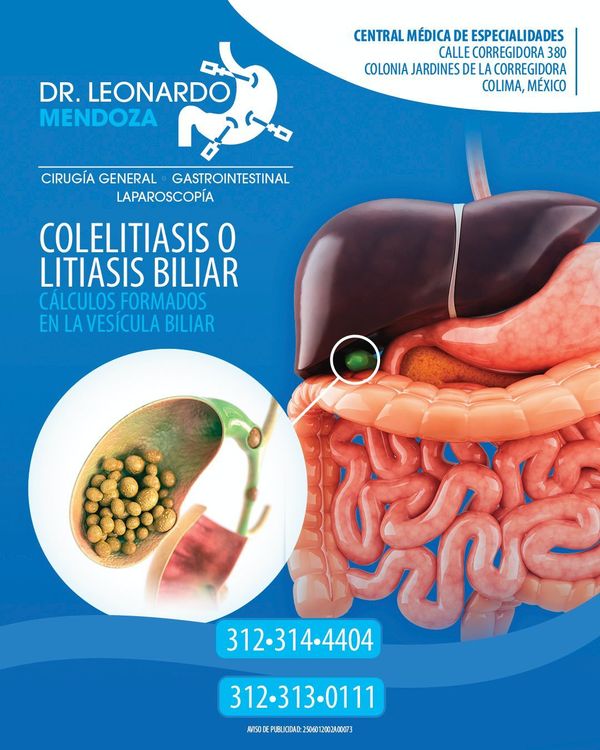 COLELITIASIS