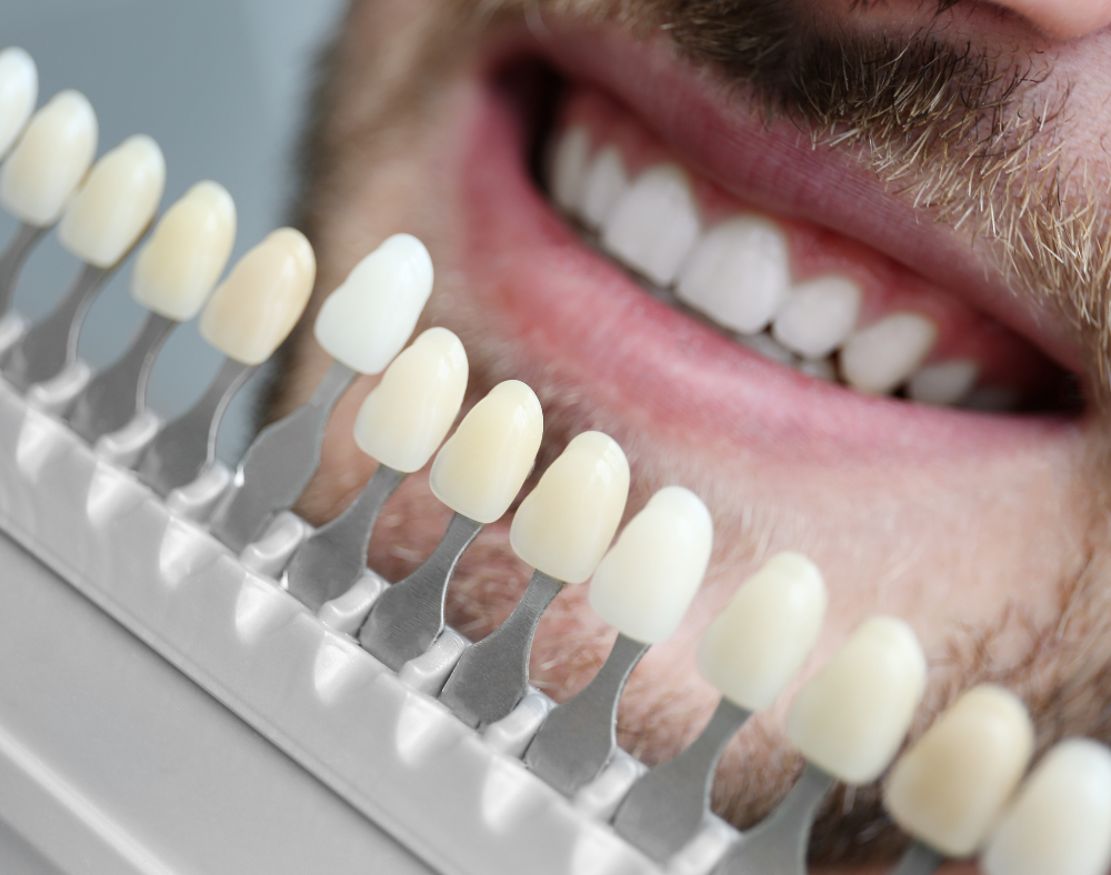 A close up of a man 's teeth with a tooth color chart for Veneers